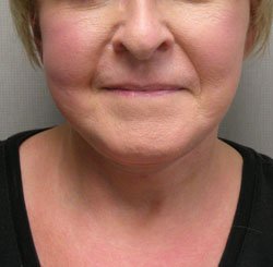 facelift after photo by michigan cosmetic surgery in southfield mi