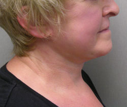 facelift after photo by michigan cosmetic surgery in southfield mi