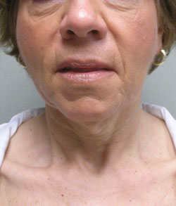 facelift before photo by michigan cosmetic surgery in southfield mi