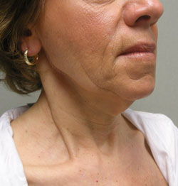 facelift before photo by michigan cosmetic surgery in southfield mi