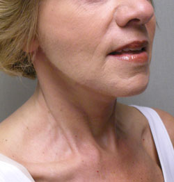 facelift after photo by michigan cosmetic surgery in southfield mi