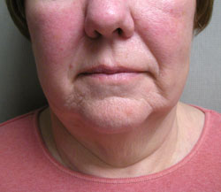 facelift before photo by michigan cosmetic surgery in southfield mi