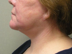 facelift after photo by michigan cosmetic surgery in southfield mi