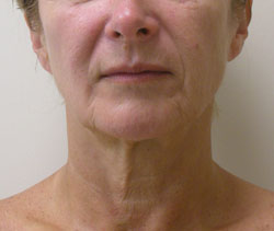 facelift before photo by michigan cosmetic surgery in southfield mi