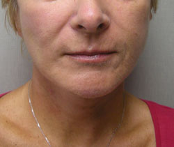 facelift after photo by michigan cosmetic surgery in southfield mi