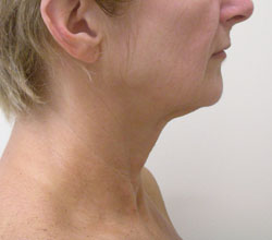 facelift before photo by michigan cosmetic surgery in southfield mi