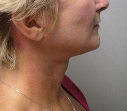 facelift after photo by michigan cosmetic surgery in southfield mi