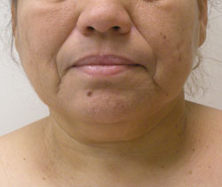facelift before photo by michigan cosmetic surgery in southfield mi