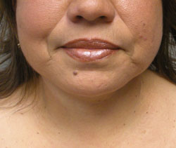 facelift after photo by michigan cosmetic surgery in southfield mi