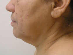 facelift before photo by michigan cosmetic surgery in southfield mi
