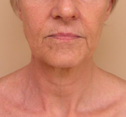 facelift before photo by michigan cosmetic surgery in southfield mi