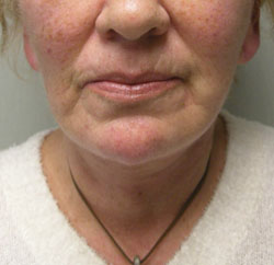 facelift after photo by michigan cosmetic surgery in southfield mi