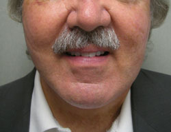 facelift after photo by michigan cosmetic surgery in southfield mi