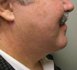 facelift after photo by michigan cosmetic surgery in southfield mi