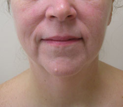 facelift before photo by michigan cosmetic surgery in southfield mi