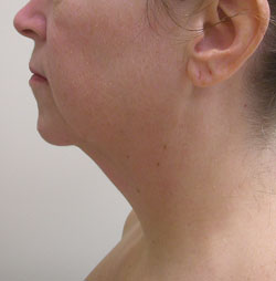 facelift before photo by michigan cosmetic surgery in southfield mi