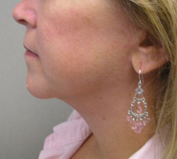 facelift after photo by michigan cosmetic surgery in southfield mi