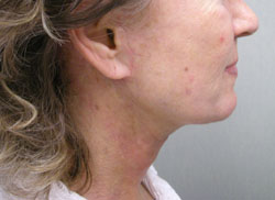 facelift after photo by michigan cosmetic surgery in southfield mi