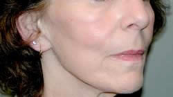 facelift before photo by michigan cosmetic surgery in southfield mi