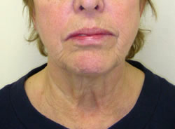 facelift before photo by michigan cosmetic surgery in southfield mi