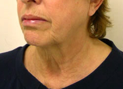 facelift before photo by michigan cosmetic surgery in southfield mi