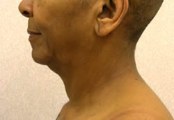 facelift before photo by michigan cosmetic surgery in southfield mi