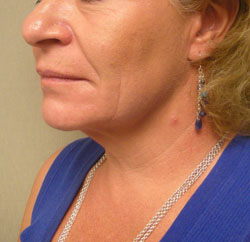 facelift before photo by michigan cosmetic surgery in southfield mi