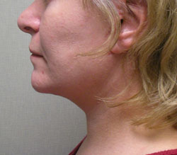facelift after photo by michigan cosmetic surgery in southfield mi