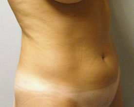 liposuction before photo by michigan cosmetic surgery in southfield mi