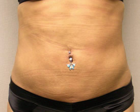 liposuction after photo by michigan cosmetic surgery in southfield mi