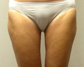 liposuction after photo by michigan cosmetic surgery in southfield mi