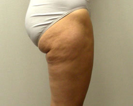 liposuction after photo by michigan cosmetic surgery in southfield mi