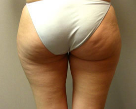 liposuction before photo by michigan cosmetic surgery in southfield mi