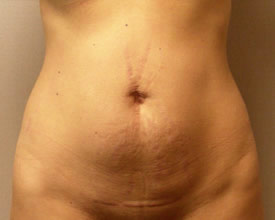 liposuction before photo by michigan cosmetic surgery in southfield mi