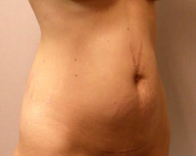 liposuction before photo by michigan cosmetic surgery in southfield mi
