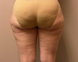 liposuction before photo by michigan cosmetic surgery in southfield mi