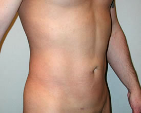 liposuction after photo by michigan cosmetic surgery in southfield mi