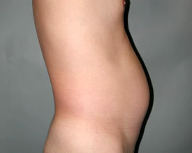 liposuction before photo by michigan cosmetic surgery in southfield mi