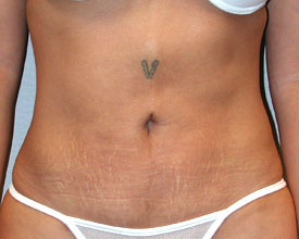 liposuction after photo by michigan cosmetic surgery in southfield mi