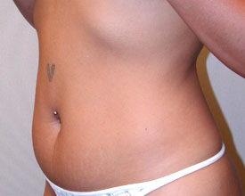 liposuction before photo by michigan cosmetic surgery in southfield mi