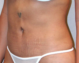 liposuction after photo by michigan cosmetic surgery in southfield mi