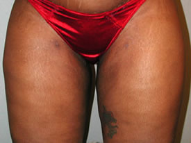 liposuction after photo by michigan cosmetic surgery in southfield mi