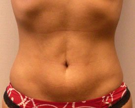 liposuction after photo by michigan cosmetic surgery in southfield mi