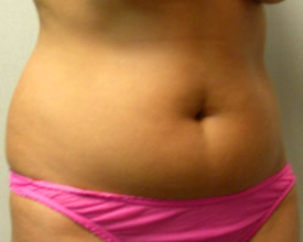 liposuction before photo by michigan cosmetic surgery in southfield mi