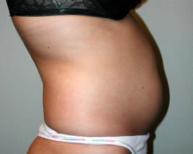 liposuction before photo by michigan cosmetic surgery in southfield mi