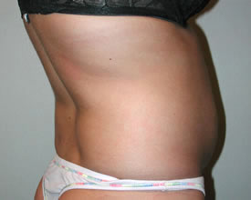 liposuction before photo by michigan cosmetic surgery in southfield mi