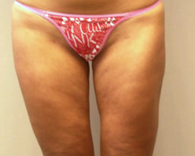 liposuction after photo by michigan cosmetic surgery in southfield mi