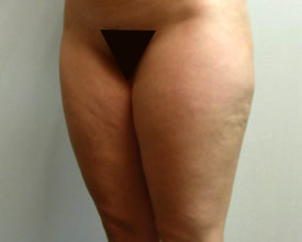 liposuction before photo by michigan cosmetic surgery in southfield mi