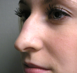 rhinoplasty before photo by michigan cosmetic surgery in southfield mi