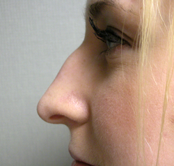 rhinoplasty before photo by michigan cosmetic surgery in southfield mi